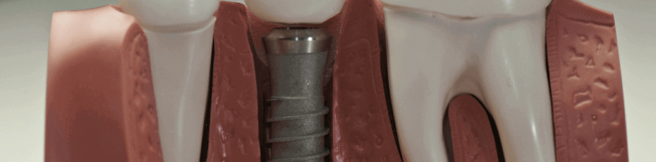 what to think about while thinking about dental implants