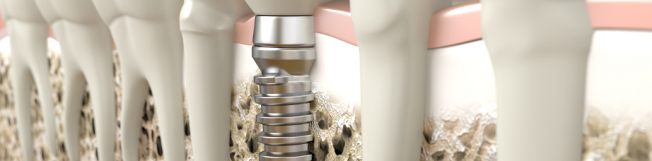 considering-dental-implants-what-you-need-to-know