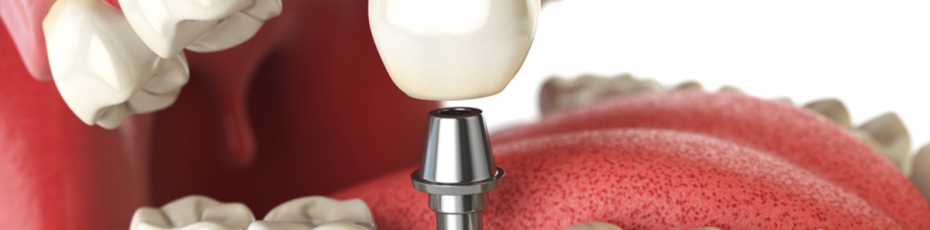 why consider dental implants