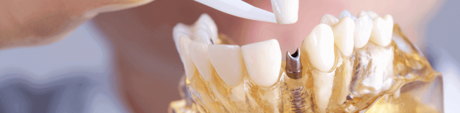 what are the benefits of having dental implants