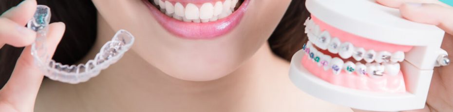 invisalign vs braces: how to know what is best for you